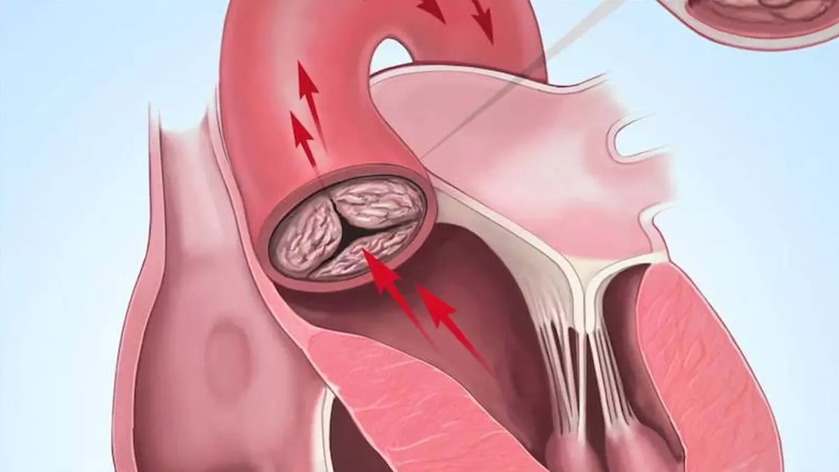 Aort yırtılması nedir, neden olur? Aort yırtılmasının tedavisi var mı?